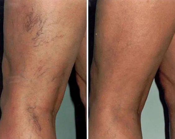 Before and after vein restoration