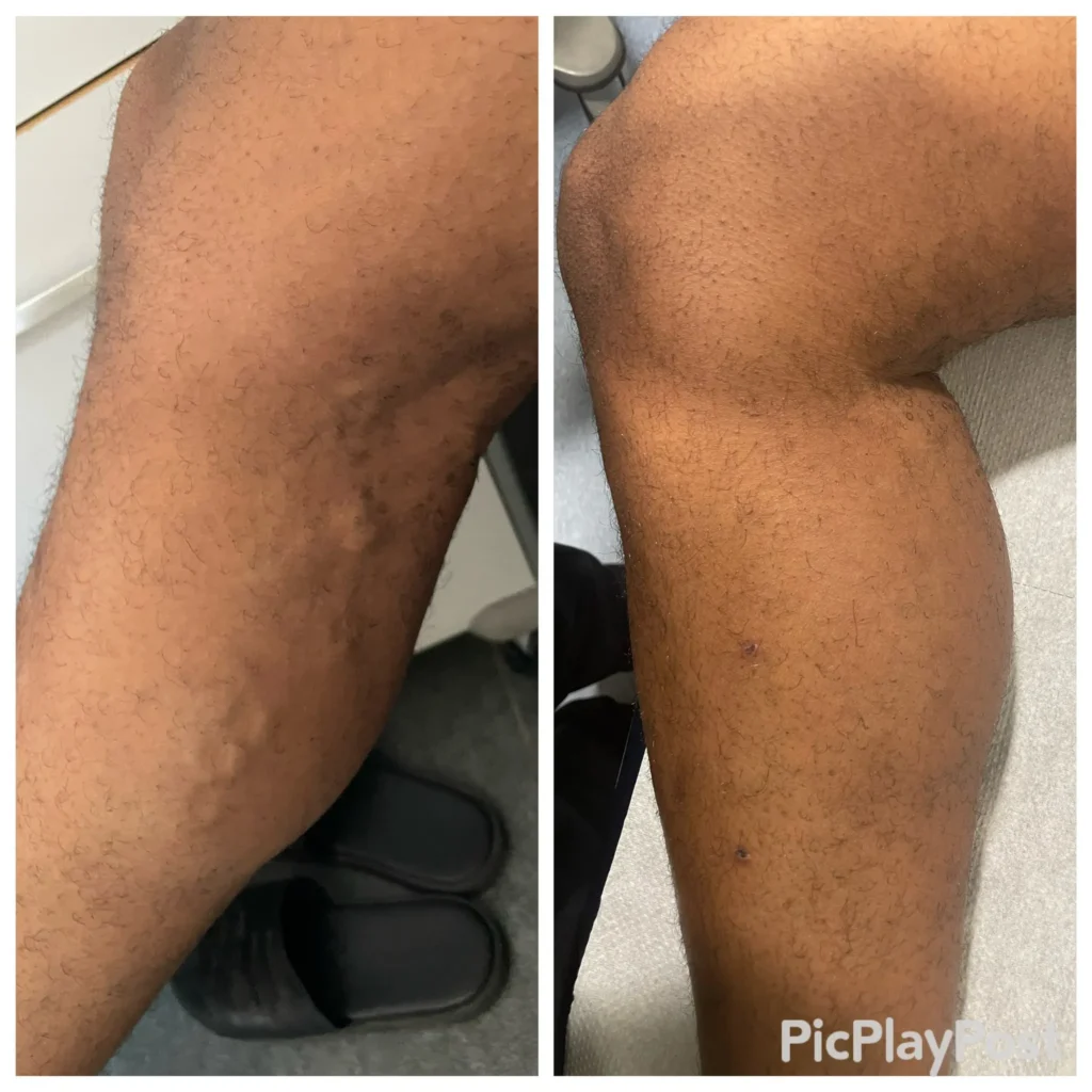 VeinRestore Medical Spray